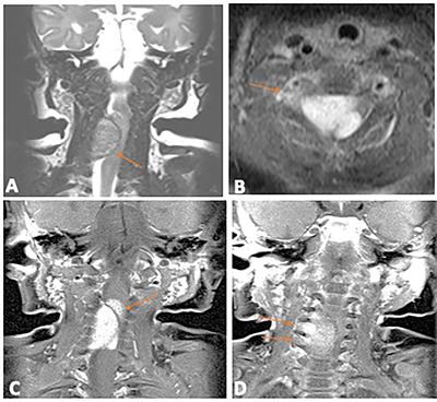 Congenital midline spinal hamartoma in an infant with DICER1 syndrome: A case report